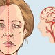 Illustration for article titled Obat Stroke Akibat Darah Tinggiem/em